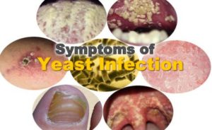 Symptoms of Yeast Infection
