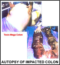 Impacted-Mega-Colon